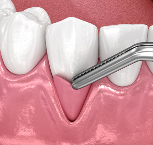 Illustration of gum graft being placed on tooth root